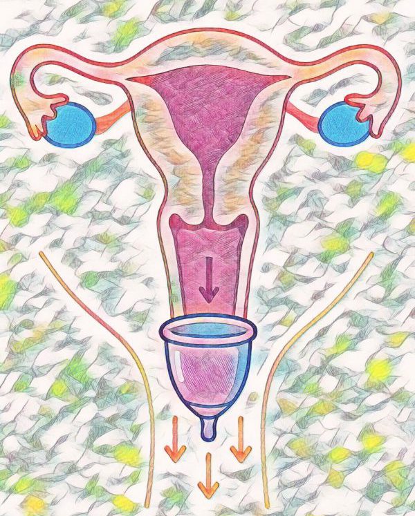 kleurijke schematische illustratie van baarmoeder,eierstokken en vagina gezien van voor. Met in de vagina naar beneden glijdende menstruatiecup
